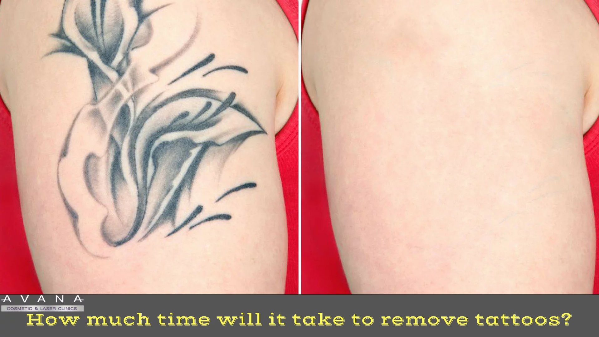 How much time will it take to remove tattoos? - Avana