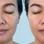 A woman with melasma before and after pic