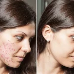 Acne before and after of a woman's face