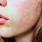 A woman's face with rosacea