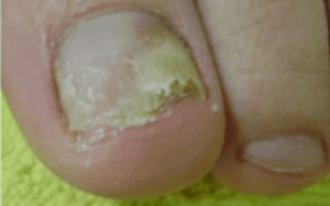 Toenail Fungus Treatment - Avana Cosmetic & Laser Clinic