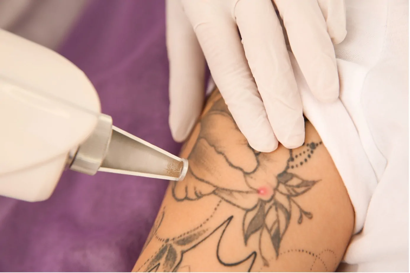 Your Tattoo Removal FAQs Answered - Avana