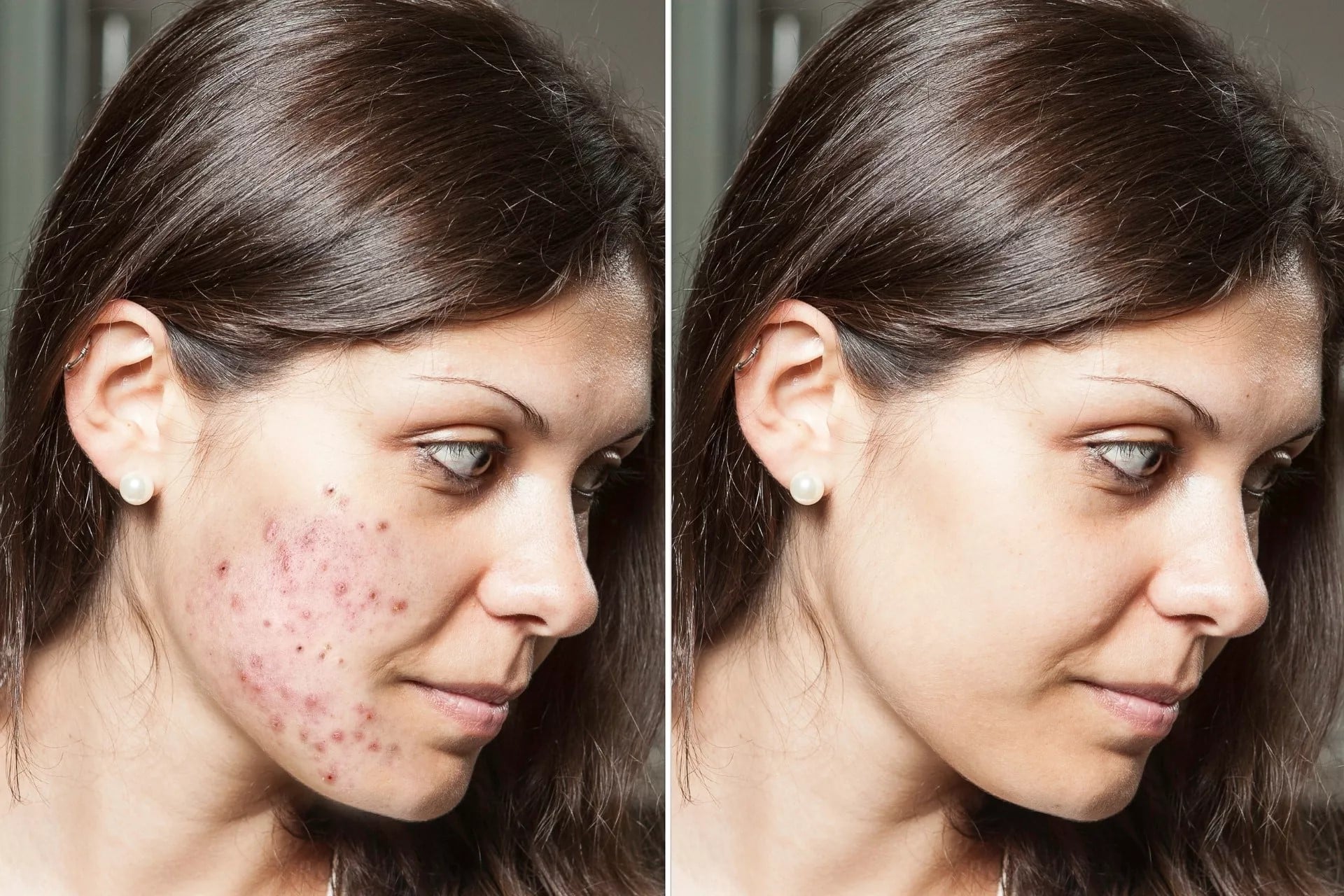 Acne treatment in Auckland