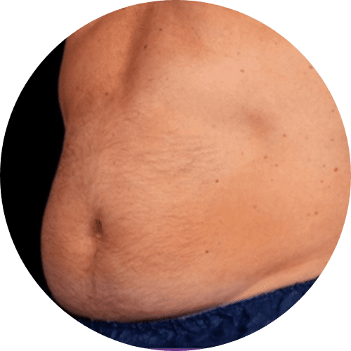 Body sculpting and body contouring 1