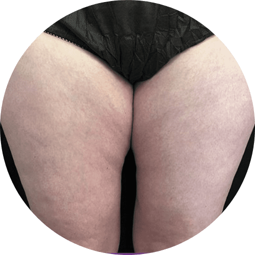 Body sculpting and body countoring 8