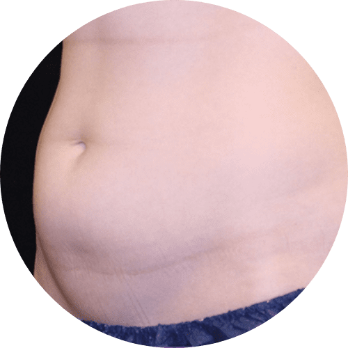 Body sculpting and body countoring 3