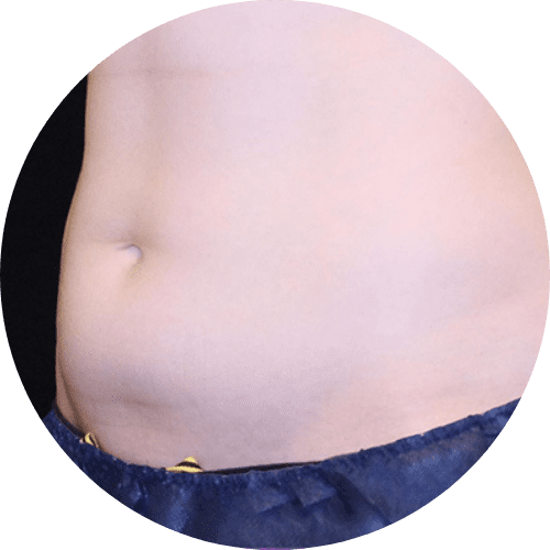 Body sculpting and body countoring 4