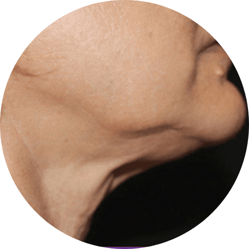 Body sculpting and body countoring 5