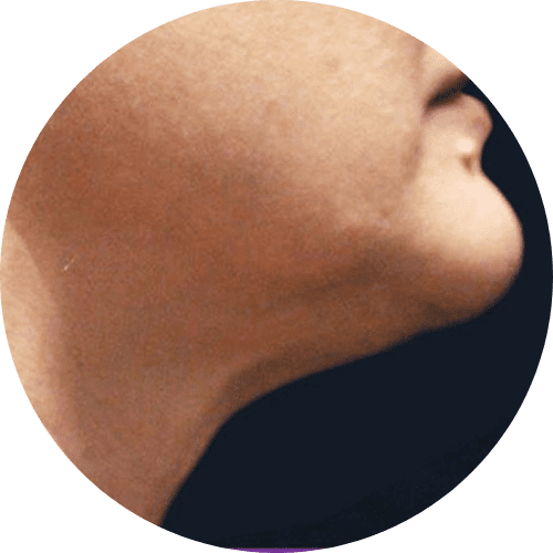 Body sculpting and body contoring 2