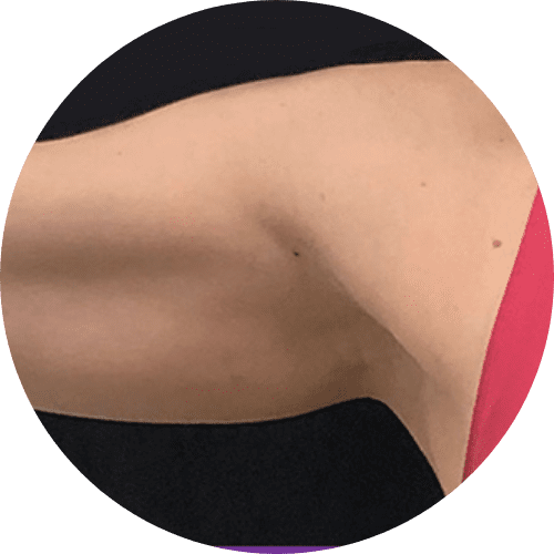 Body sculpting and body countoring 8