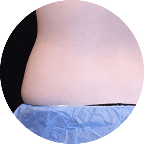 Body sculpting and body countoring 9