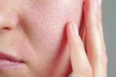 Enlarged pores