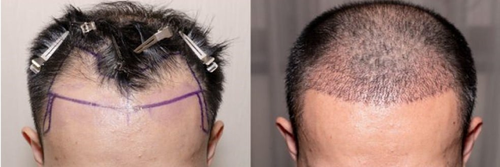 Hair transplant