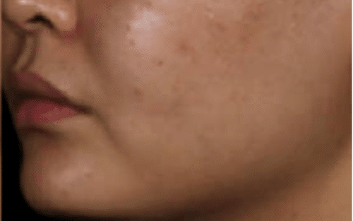 Pico Laser FX